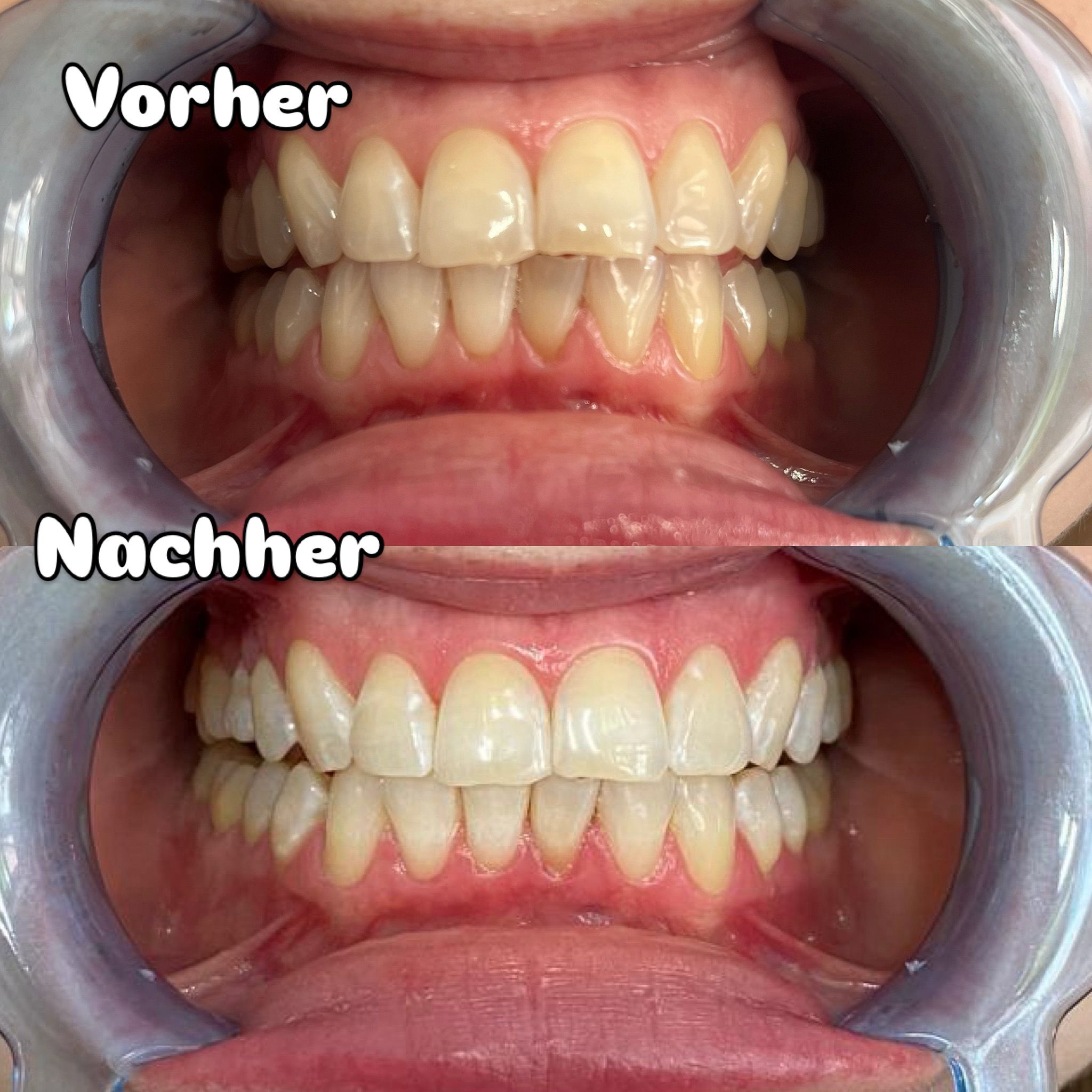 Zahnbleaching